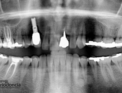 Rehabilitación tridimensional en la zona estética, diente 2.1